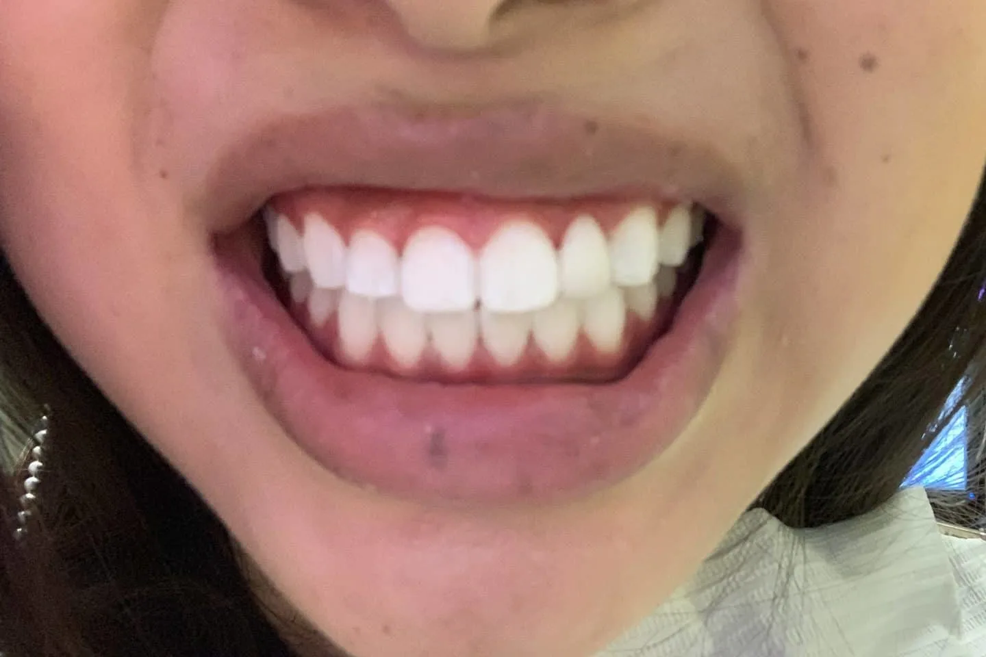 A review of the Philips Zoom teeth whitening procedure, including everything you need to know before and after getting it done!