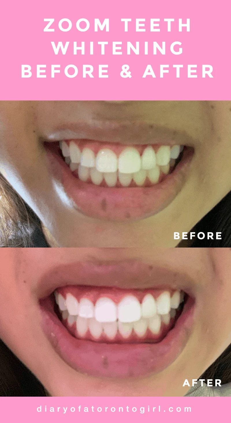 Philips Zoom teeth whitening at Altima Dental Toronto